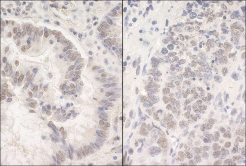 Detection of Human and Mouse PUF60 by Immunohistochemistry. Sample: FFPE section of human colon carcinoma (left) and mouse teratoma (right). Antibody: Affinity purified rabbit anti-PUF60 used at a dilution of 1:200 (1 ug/mg).