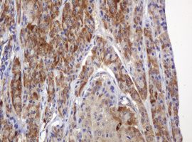 IHC of paraffin-embedded Carcinoma of Human thyroid tissue using anti-TBC1D13 mouse monoclonal antibody.