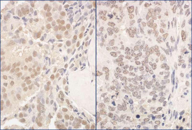 Detection of Human and Mouse PUF60 by Immunohistochemistry. Sample: FFPE section of human prostate carcinoma (left) and mouse teratoma (right). Antibody: Affinity purified rabbit anti-PUF60 used at a dilution of 1:200 (1 ug/mg).
