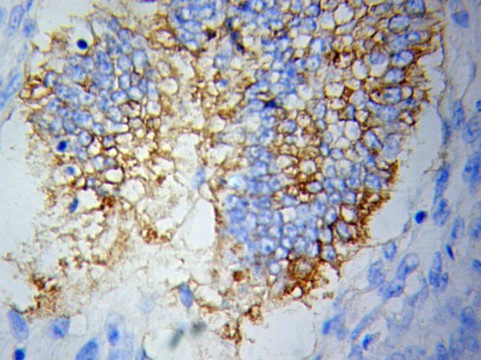 Immunohistochemistry (IHC) analysis of TBRG4 pAb in paraffin-embedded Lymphoma tissue.