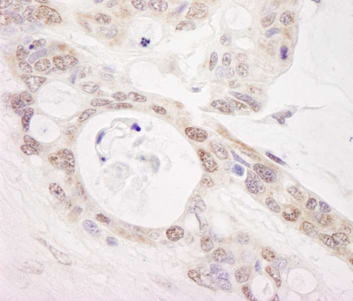 Detection of Human PUS1 by Immunohistochemistry. Sample: FFPE section of human ovarian carcinoma. Antibody: Affinity purified rabbit anti-PUS1 used at a dilution of 1:1000 (0.2 ug/ml). Detection: DAB.