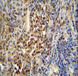 PUS3 antibody immunohistochemistry of formalin-fixed and paraffin-embedded human lung carcinoma followed by peroxidase-conjugated secondary antibody and DAB staining.
