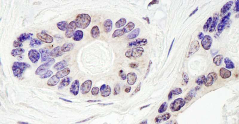Detection of Human TDP1 by Immunohistochemistry. Sample: FFPE section of human ovarian carcinoma. Antibody: Affinity purified rabbit anti-TDP1 used at a dilution of 1:1000 (0.2 ug/ml). Detection: DAB.