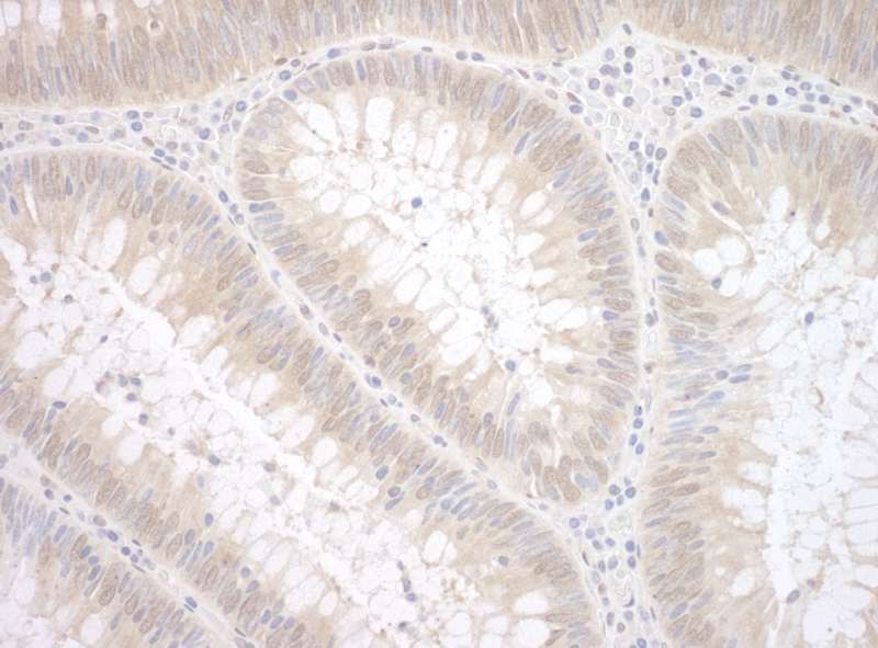 Detection of Human TDP2 by Immunohistochemistry. Sample: FFPE section of human colon carcinoma. Antibody: Affinity purified rabbit anti-TDP2 used at a dilution of 1:200 (1 ug/mg).