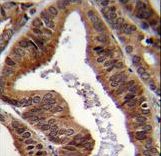 EAPII Antibody immunohistochemistry of formalin-fixed and paraffin-embedded human prostate carcinoma followed by peroxidase-conjugated secondary antibody and DAB staining.