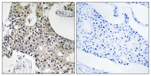 IHC of paraffin-embedded human breast carcinoma tissue, using GPSN2 Antibody. The sample on the right was incubated with synthetic peptide.