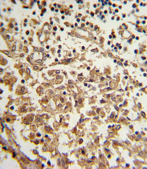 Formalin-fixed and paraffin-embedded human lymph with TERT Antibody (S1125), which was peroxidase-conjugated to the secondary antibody, followed by DAB staining. This data demonstrates the use of this antibody for immunohistochemistry; clinical relevance has not been evaluated.