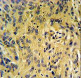 TESC Antibody IHC of formalin-fixed and paraffin-embedded human lung carcinoma followed by peroxidase-conjugated secondary antibody and DAB staining.
