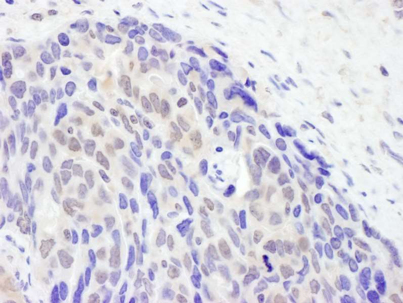 Detection of Human TET2 by Immunohistochemistry. Sample: FFPE section of human ovarian carcinoma. Antibody: Affinity purified rabbit anti-TET2 used at a dilution of 1:5000 (0.2 Detection: DAB.