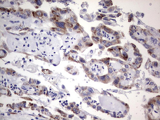 IHC of paraffin-embedded Adenocarcinoma of Human ovary tissue using anti-TET3 mouse monoclonal antibody. (Heat-induced epitope retrieval by 1 mM EDTA in 10mM Tris, pH8.5, 120°C for 3min).
