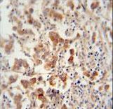 TEX13B antibody immunohistochemistry of formalin-fixed and paraffin-embedded human testis carcinoma followed by peroxidase-conjugated secondary antibody and DAB staining.