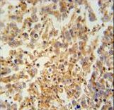 TEX9 antibody immunohistochemistry of formalin-fixed and paraffin-embedded human testis carcinoma followed by peroxidase-conjugated secondary antibody and DAB staining.