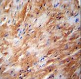TFB2M Antibody immunohistochemistry of formalin-fixed and paraffin-embedded human heart carcinoma followed by peroxidase-conjugated secondary antibody and DAB staining.