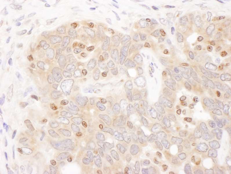 Detection of Human TFEB by Immunohistochemistry. Sample: FFPE section of human ovarian carcinoma. Antibody: Affinity purified rabbit anti-TFEB used at a dilution of 1:1000 (1 Detection: DAB.