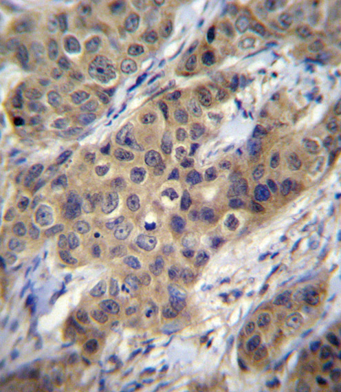 TGFB1 Antibody immunohistochemistry of formalin-fixed and paraffin-embedded human breast carcinoma followed by peroxidase-conjugated secondary antibody and DAB staining.