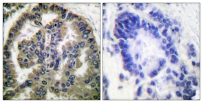 IHC of paraffin-embedded human lung carcinoma tissue, using TGF beta2 Antibody. The picture on the right is treated with the synthesized peptide.