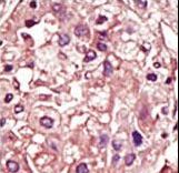 Formalin-fixed and paraffin-embedded human cancer tissue reacted with the primary antibody, which was peroxidase-conjugated to the secondary antibody, followed by AEC staining. This data demonstrates the use of this antibody for immunohistochemistry; clinical relevance has not been evaluated. BC = breast carcinoma; HC = hepatocarcinoma.