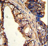 Formalin-fixed and paraffin-embedded human prostate carcinoma with TGM4 Antibody , which was peroxidase-conjugated to the secondary antibody, followed by DAB staining. This data demonstrates the use of this antibody for immunohistochemistry; clinical relevance has not been evaluated.