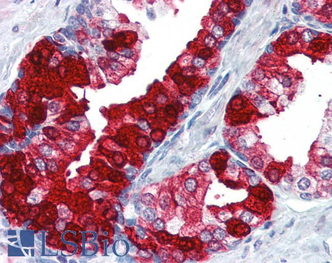 Anti-TGM4 / Transglutaminase 4 antibody IHC of human prostate. Immunohistochemistry of formalin-fixed, paraffin-embedded tissue after heat-induced antigen retrieval. Antibody LS-B3056 concentration 5 ug/ml.