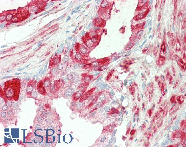 Anti-TGM4 / Transglutaminase 4 antibody IHC staining of human prostate. Immunohistochemistry of formalin-fixed, paraffin-embedded tissue after heat-induced antigen retrieval. Antibody LS-B11180 concentration 5 ug/ml.