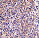 THEMIS Antibody immunohistochemistry of formalin-fixed and paraffin-embedded human thymoma followed by peroxidase-conjugated secondary antibody and DAB staining.