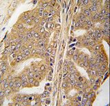 Formalin-fixed and paraffin-embedded human prostate carcinoma tissue reacted with PXN Antibody (Y118) , which was peroxidase-conjugated to the secondary antibody, followed by DAB staining. This data demonstrates the use of this antibody for immunohistochemistry; clinical relevance has not been evaluated.