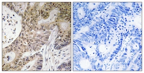 IHC of paraffin-embedded human colon carcinoma tissue, using PRPF6 Antibody. The sample on the right was incubated with synthetic peptide.