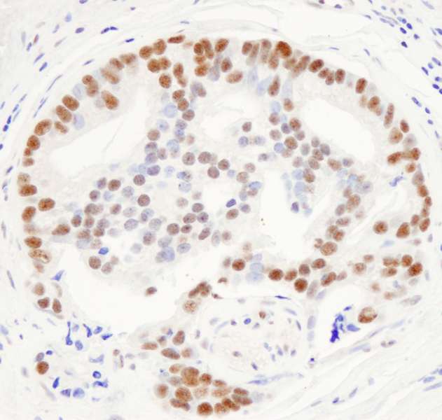 Detection of Human THRAP3/TRAP150 by Immunohistochemistry. Sample: FFPE section of human prostate carcinoma. Antibody: Affinity purified rabbit anti-THRAP3/TRAP150 used at a dilution of 1:1000 (0.2 ug/ml). Detection: DAB.