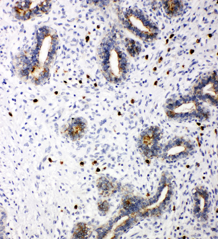 TICAM1 / TRIF antibody. IHC(P): Human Breast Cancer Tissue.