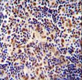 TIGD3 antibody immunohistochemistry of formalin-fixed and paraffin-embedded human Hodgkin lymphoma followed by peroxidase-conjugated secondary antibody and DAB staining.
