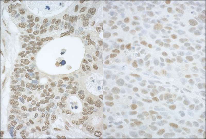 Detection of Human and Mouse CAND1 by Immunohistochemistry. Sample: FFPE section of human ovarian carcinoma (left) and mouse hybridoma tumor (right). Antibody: Affinity purified rabbit anti-CAND1 used at a dilution of 1:5000 (0.2and 1:1000 (1 Detection: DAB.