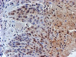 IHC of paraffin-embedded Carcinoma of Human bladder tissue using anti-RUVBL2 mouse monoclonal antibody.