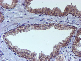 IHC of paraffin-embedded Carcinoma of Human prostate tissue using anti-RUVBL2 mouse monoclonal antibody.