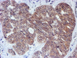 IHC of paraffin-embedded Adenocarcinoma of Human ovary tissue using anti-RUVBL2 mouse monoclonal antibody.