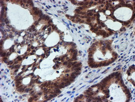 IHC of paraffin-embedded Adenocarcinoma of Human colon tissue using anti-RUVBL2 mouse monoclonal antibody.