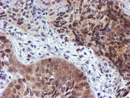 IHC of paraffin-embedded Carcinoma of Human lung tissue using anti-RUVBL2 mouse monoclonal antibody.