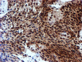IHC of paraffin-embedded Carcinoma of Human bladder tissue using anti-RUVBL2 mouse monoclonal antibody.