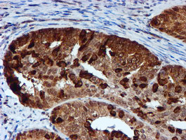 IHC of paraffin-embedded Adenocarcinoma of Human endometrium tissue using anti-RUVBL2 mouse monoclonal antibody.