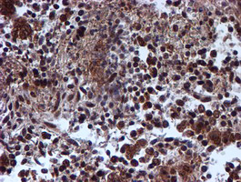 IHC of paraffin-embedded Adenocarcinoma of Human ovary tissue using anti-RUVBL2 mouse monoclonal antibody.