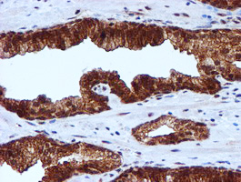 IHC of paraffin-embedded Carcinoma of Human prostate tissue using anti-RUVBL2 mouse monoclonal antibody.