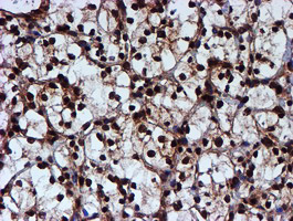 IHC of paraffin-embedded Carcinoma of Human kidney tissue using anti-RUVBL2 mouse monoclonal antibody.