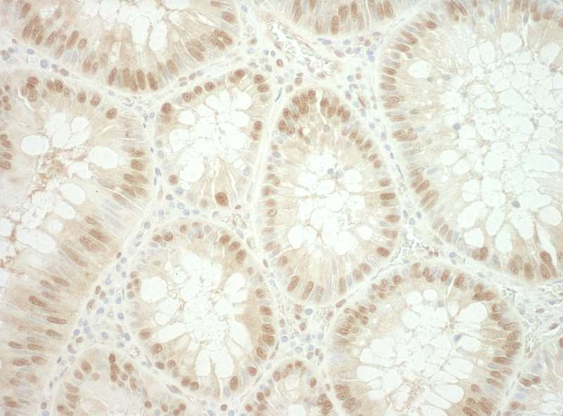 Detection of Human RuvBL2 by Immunohistochemistry. Sample: FFPE section of human colon carcinoma. Antibody: Affinity purified rabbit anti-RuvBL2 used at a dilution of 1:250.