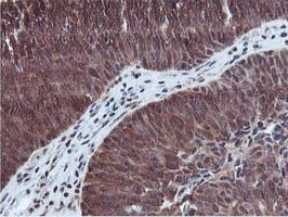 IHC of paraffin-embedded Carcinoma of Human bladder tissue using anti-RUVBL2 mouse monoclonal antibody.