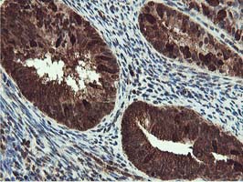 IHC of paraffin-embedded Adenocarcinoma of Human endometrium tissue using anti-RUVBL2 mouse monoclonal antibody.