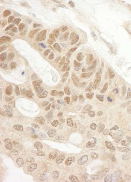 Detection of Human Tip41 by Immunohistochemistry. Sample: FFPE section of human ovarian carcinoma. Antibody: Affinity purified rabbit anti-Tip41 used at a dilution of 1:200 (1 ug/ml). Detection: DAB.