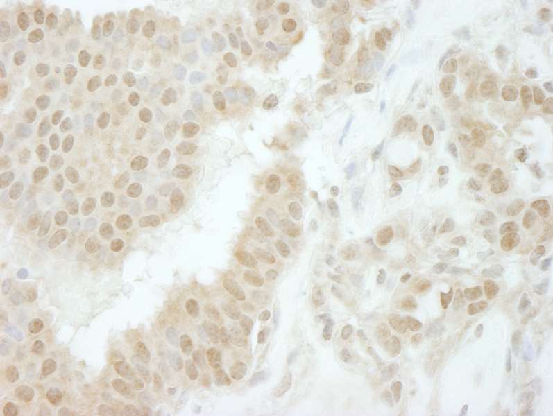 Detection of Human Tip41 by Immunohistochemistry. Sample: FFPE section of human breast carcinoma. Antibody: Affinity purified rabbit anti-Tip41 used at a dilution of 1:250.