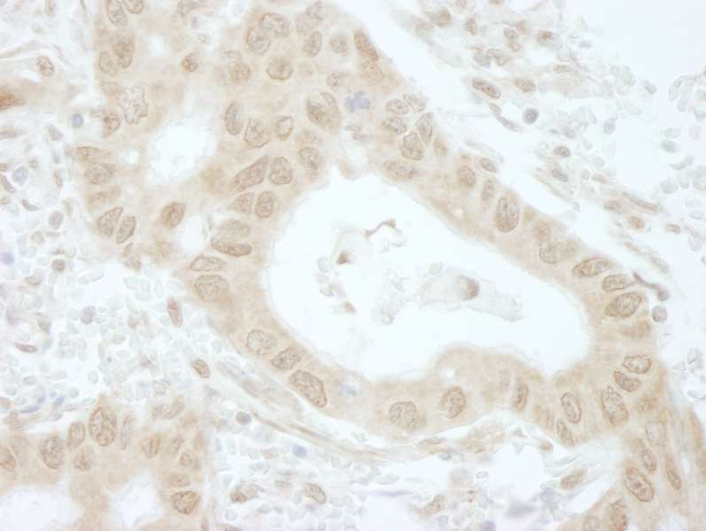 Detection of Human Tip41 by Immunohistochemistry. Sample: FFPE section of human lung adenocarcinoma. Antibody: Affinity purified rabbit anti-Tip41 used at a dilution of 1:250.