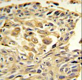ZO1 Antibody IHC of formalin-fixed and paraffin-embedded lung carcinoma followed by peroxidase-conjugated secondary antibody and DAB staining.