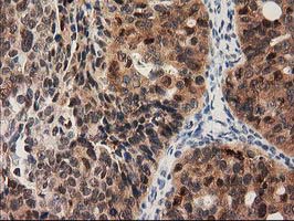 IHC of paraffin-embedded Adenocarcinoma of Human ovary tissue using anti-PYCRL mouse monoclonal antibody.