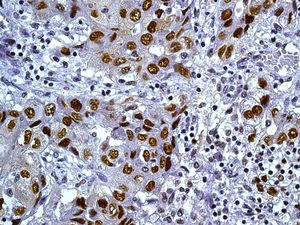 IHC of paraffin-embedded human hepatocellular carcinoma tissue using anti-TKTL2 antibody.